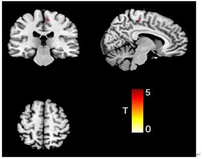 Characteristics and correlation of gray matter volume and somatic symptoms in adolescent patients with depressive disorder